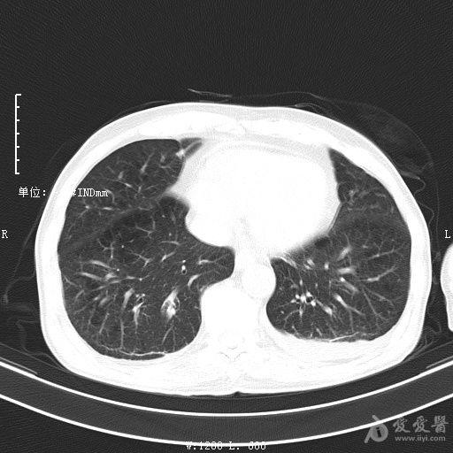 最新肺炎求助急需關注與幫助