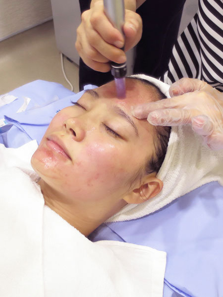 微針最新技術(shù)揭秘,三大革新重塑美容行業(yè)未來(lái)