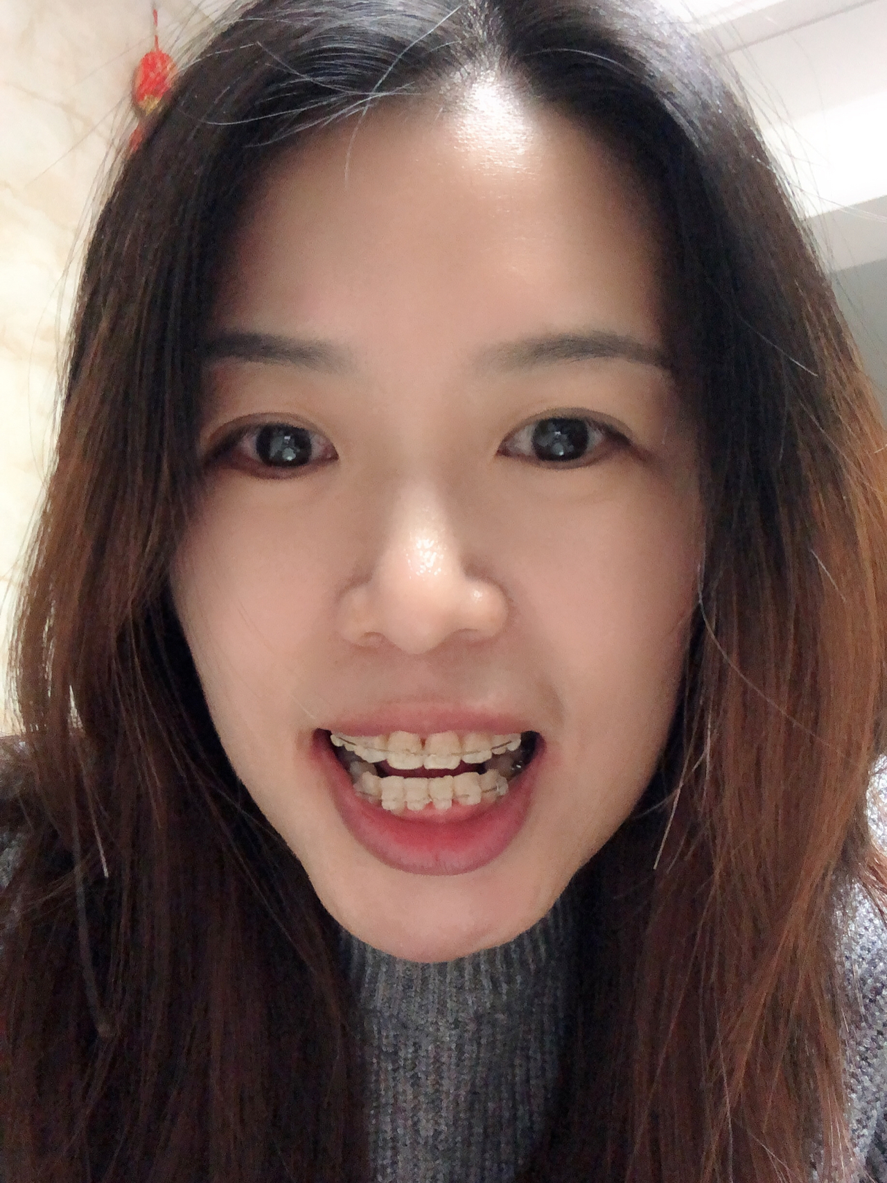 莊最新牙齒技術揭秘,牙齒美容新選擇